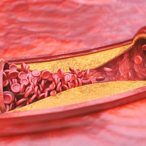Colesterol VLDL: o que é e o que você precisa saber